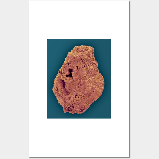 Kidney stone, SEM (C031/9839) Wall Art by SciencePhoto